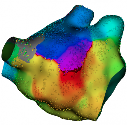 Electrophysiology Arrhythmia Treatments