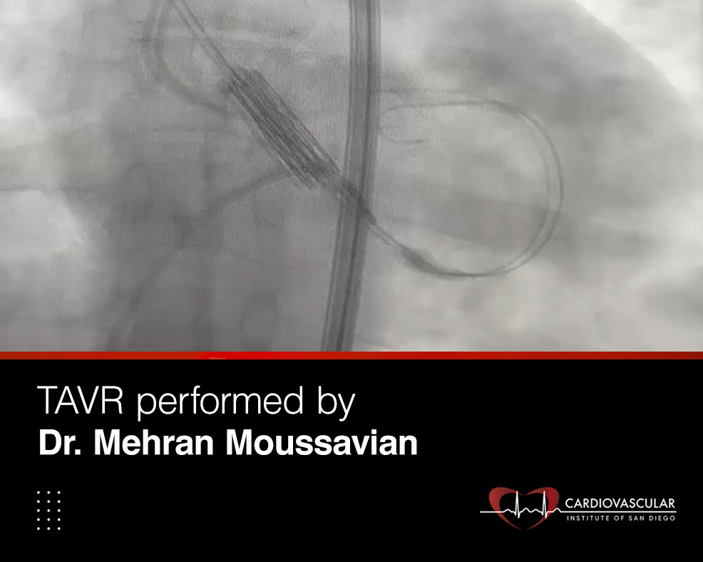 TAVR DR Mehran Moussavian
