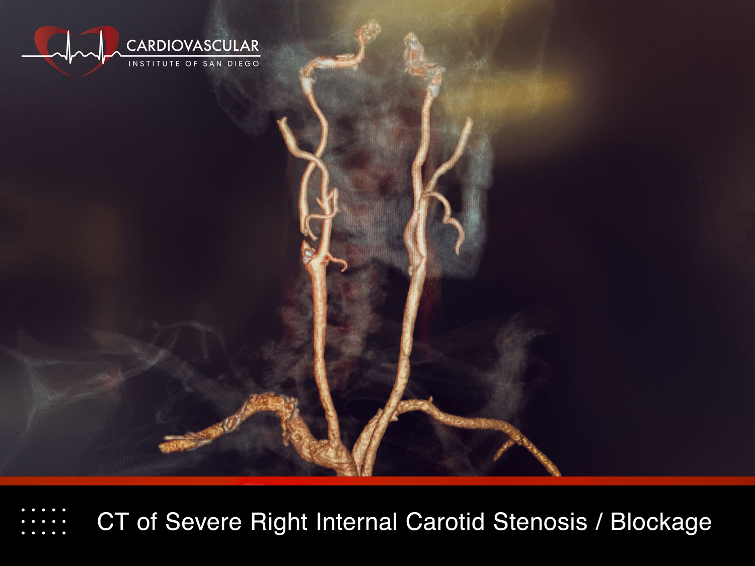 CT Stenosis Mehran Moussavian