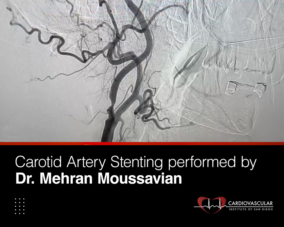 Carotid Artery Stenting performed by Dr. Mehran Moussavian