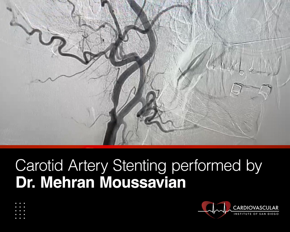 Carotid Artery Stenting Mehran Moussavian Cardiovascular San Diego