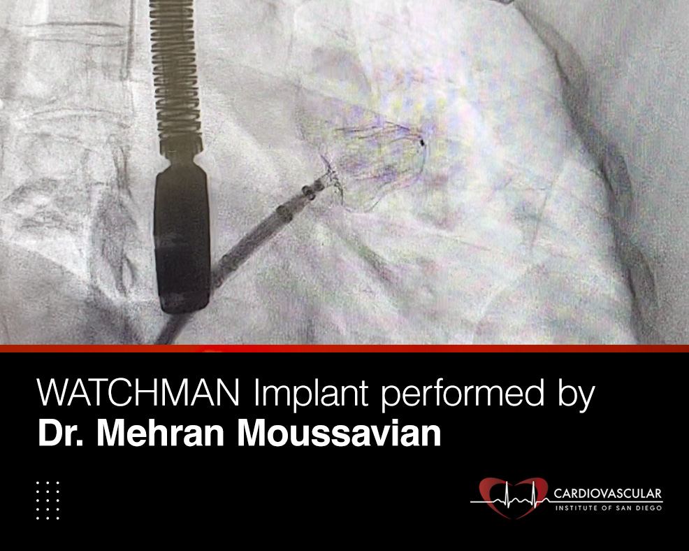 Successful WATCHMAN Implant Performed by Dr. Mehran Moussavian