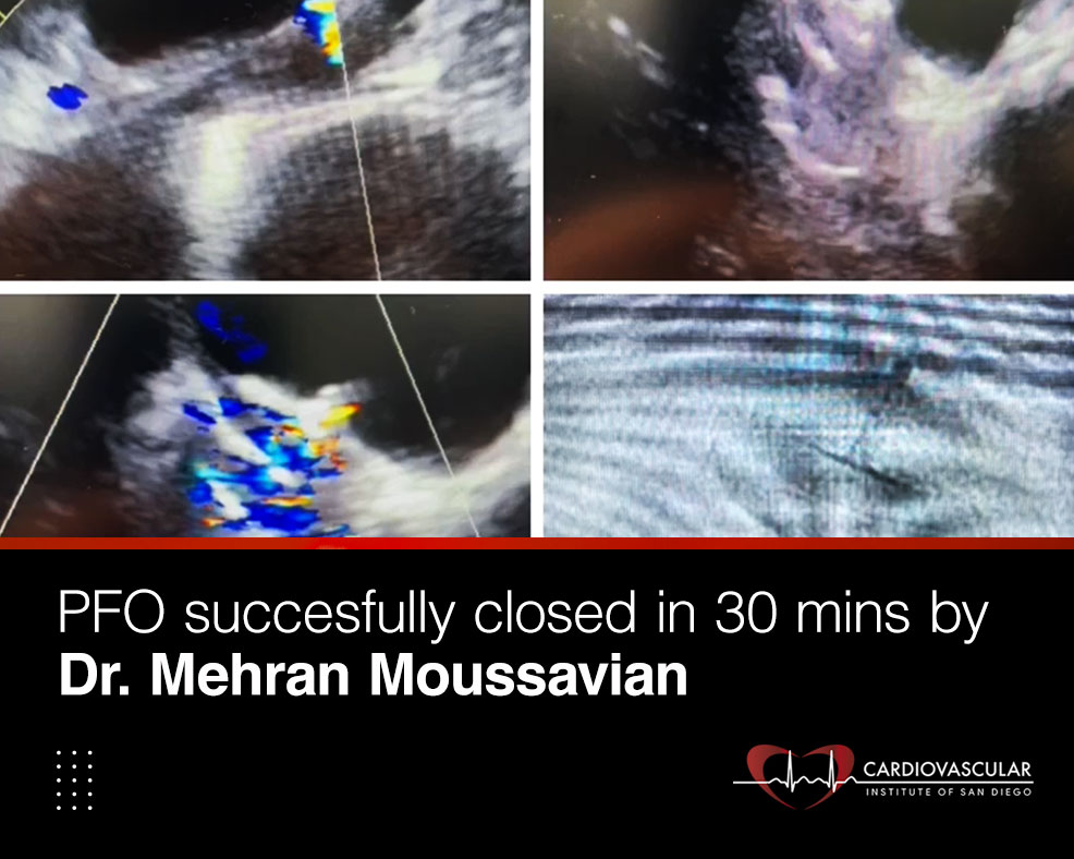 PFO Successfully Closed by Dr. Mehran Moussavian
