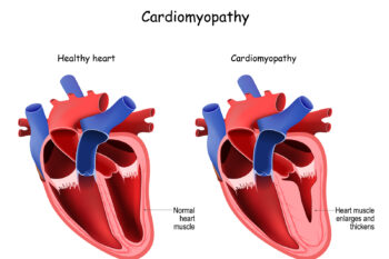 CVISD Cardiomyopathy