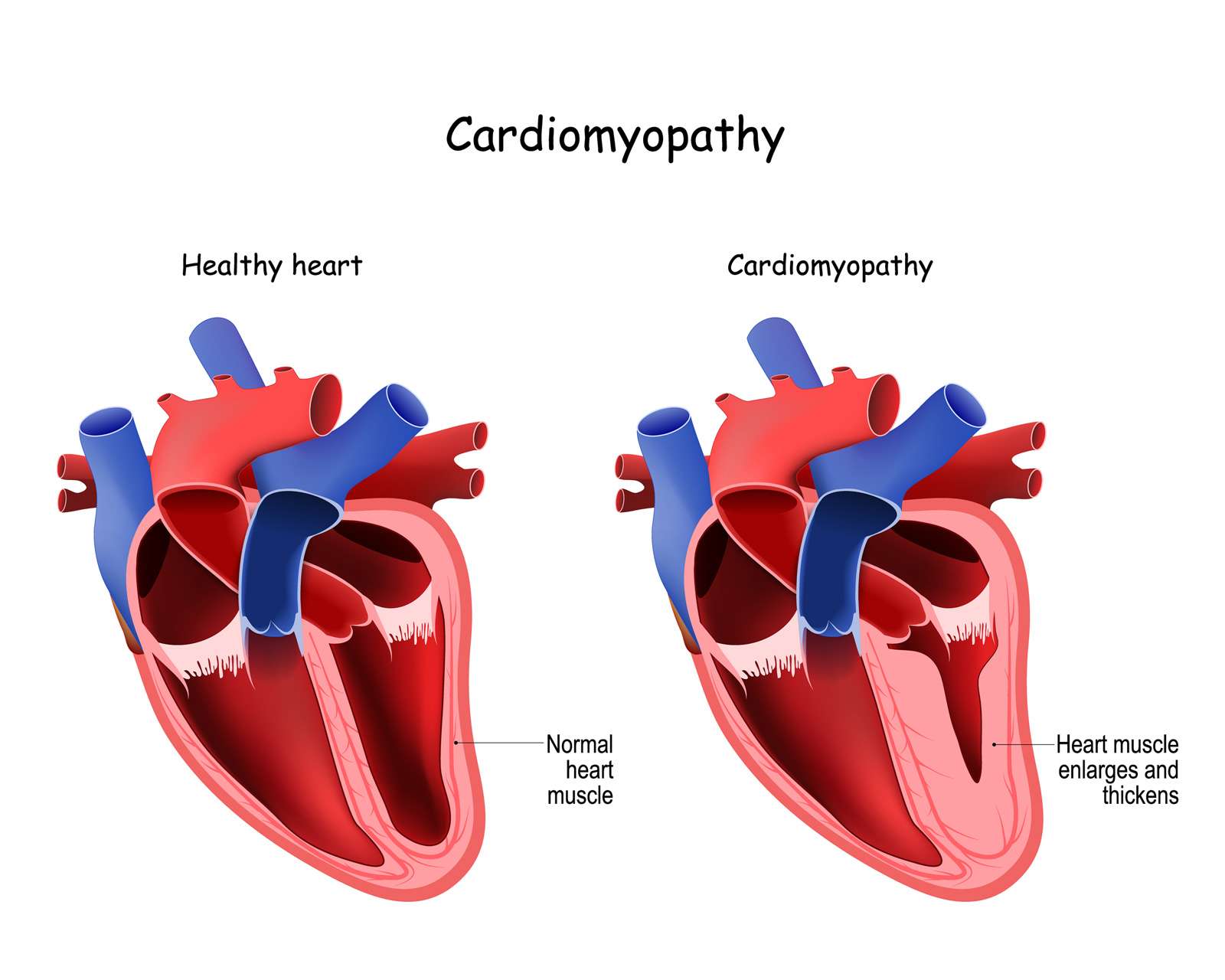 CVISD Cardiomyopathy